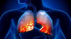 Ποια είναι η διαφορά ανάμεσα στην «περιπατητική πνευμονία» και στην πνευμονία; – Όλα τα συμπτώματα