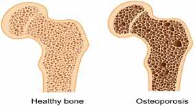 Οστεοπόρωση: Ποιες τροφές ενισχύουν τα οστά