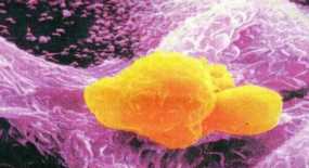 Καρκίνος του στόματος: Η ουσία που εξοντώνει τα καρκινικά κύτταρα