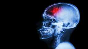 Εγκεφαλικό: Οι 3 βασικές ενδείξεις που πρέπει να σας κινητοποιήσουν
