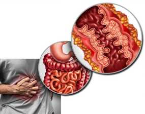 Τι είναι η νόσος του Crohn και ποια είναι τα συμπτώματά της