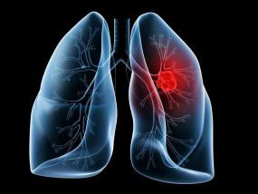 Καρκίνος στον πνεύμονα: Σημάδια και συμπτώματα