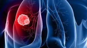 Ο καρκίνος του πνεύμονα μπορεί να κοιμάται για 20 χρόνια