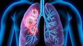 Τζανάκης: Μία μικρή πόλη χάνεται κάθε χρόνο στην Ευρώπη από καρκίνο του πνεύμονα