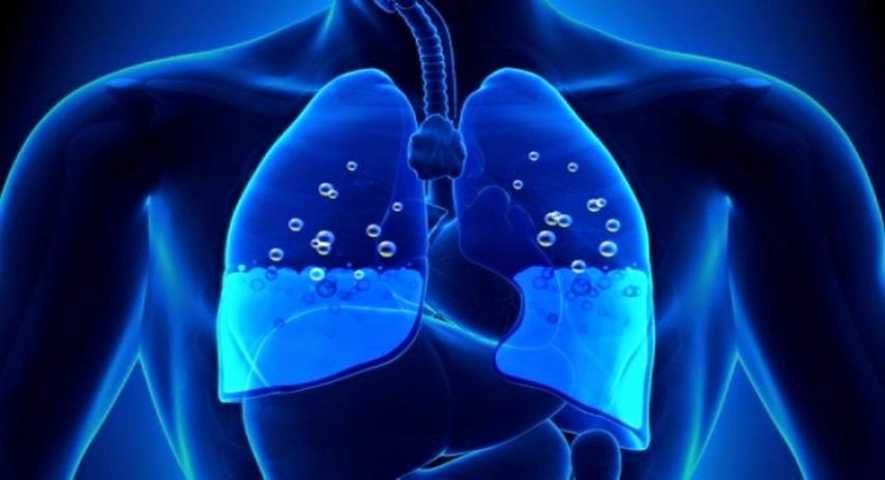 Πνευμονικό οίδημα: Αν νιώθετε αυτά έχετε συσσώρευση υγρού στον πνεύμονα