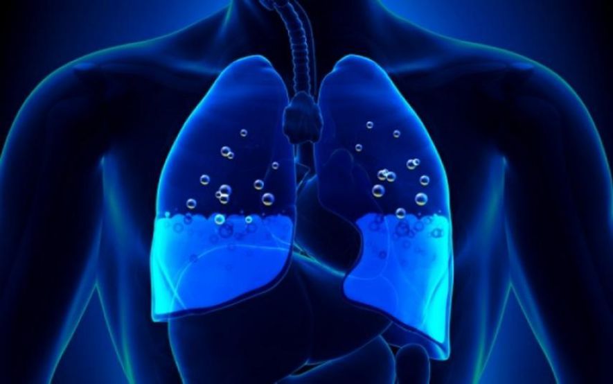 Συσσώρευση υγρού στον πνεύμονα: Πώς θα το προλάβετε