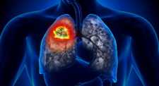 O καρκίνος του πνεύμονα αυξάνει τον κίνδυνο αυτοκτονίας του ασθενούς σύμφωνα με νέα έρευνα